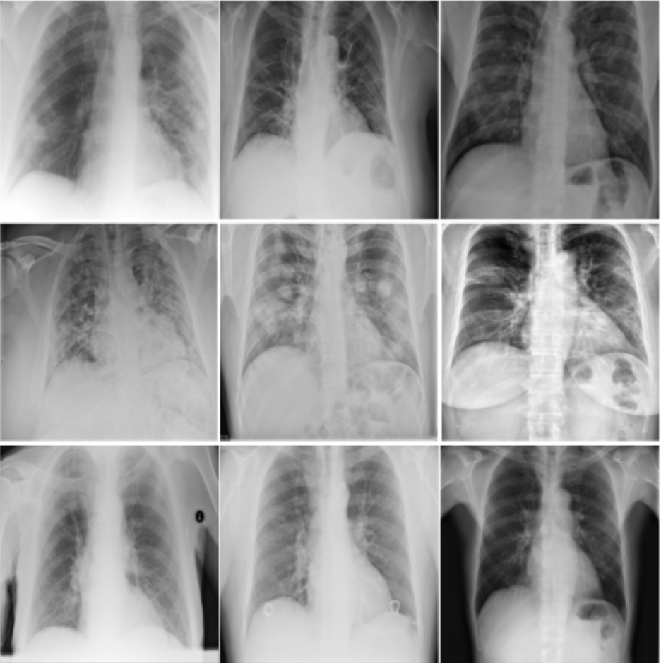  A CXR image in the COVID-Net dataset.