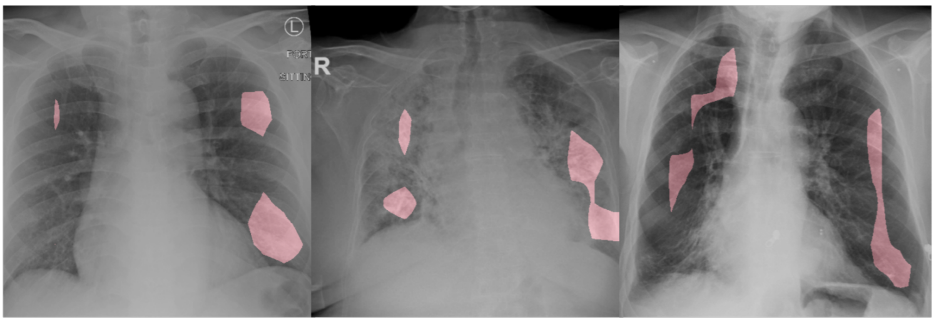  Example CXR images of COVID-19 cases.